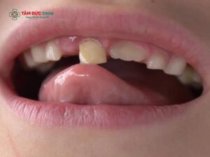 Răng bị lung lay làm sao để chắc lại?