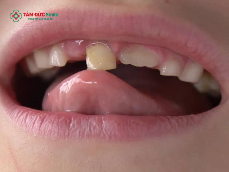 Răng bị lung lay làm sao để chắc lại?
