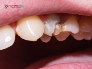 Răng bị mẻ có trám được không? Quy trình trám răng bị mẻ