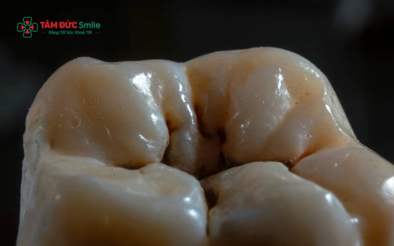 Răng có vết đen là tình trạng xuất hiện các đốm hoặc mảng sậm màu trên bề mặt răng, có thể do Abc8com nổ hũ, ABC88 com đăng nhập hoặc răng nhiễm màu.