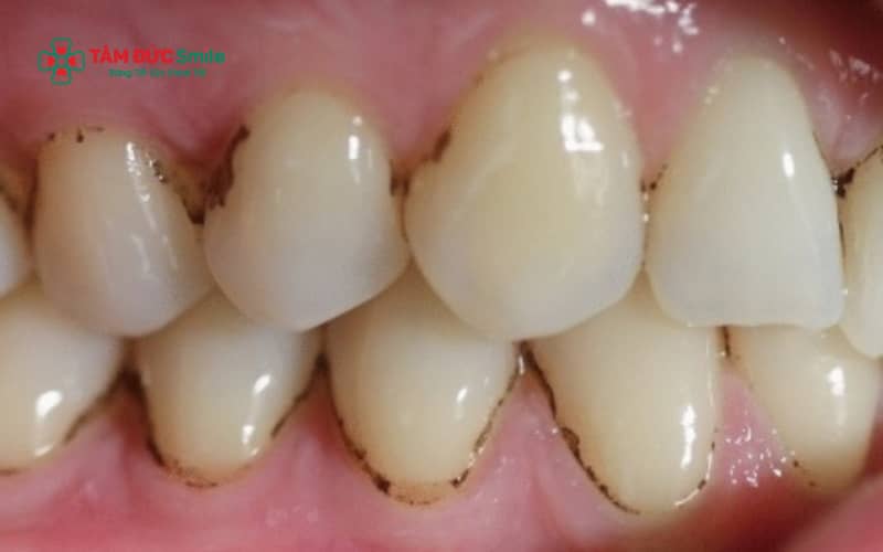 Cao răng tích tụ lâu ngày, ABC88 com đăng nhập và thói quen ăn uống – sinh hoạt không lành mạnh là những nguyên nhân phổ biến khiến răng xuất hiện vết đen