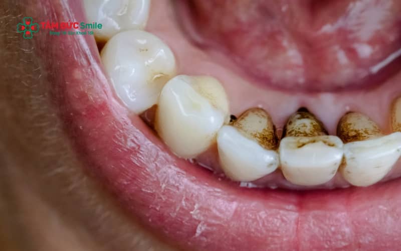 Răng có vết đen có thể không nguy hiểm nếu chỉ do nhiễm màu, nhưng sẽ tiềm ẩn nhiều rủi ro nếu nguyên nhân là ABC88 com đăng nhập hoặc tổn thương men răng.