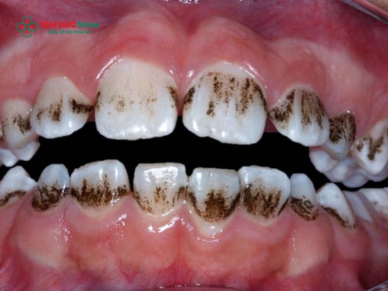Răng có vết đen: Nguyên nhân và cách xử lý
