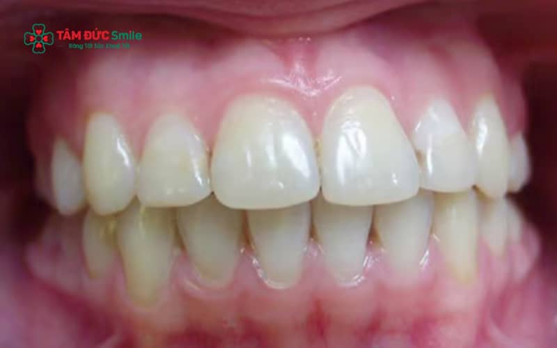 Răng cửa to và hô có thể xuất phát từ di truyền, thói quen xấu thời thơ ấu hoặc sự phát triển hàm và khớp cắn không đều