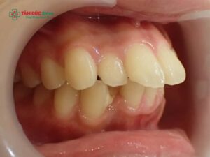 Răng cửa to và hô nên làm gì? Nguyên nhân, ảnh hưởng của răng cửa to và hô đến khuôn mặt