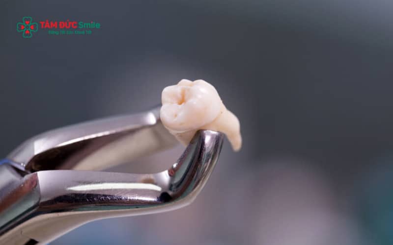 Trong trường hợp răng đang viêm cấp, nhiễm trùng lan rộng, sưng mủ hoặc sốt cao, việc nhổ răng cần được trì hoãn cho đến khi kiểm soát tình trạng viêm
