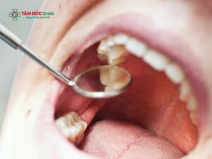 Răng đang đau có nhổ được không? Khi nào nên, khi nào cần hoãn nhổ răng