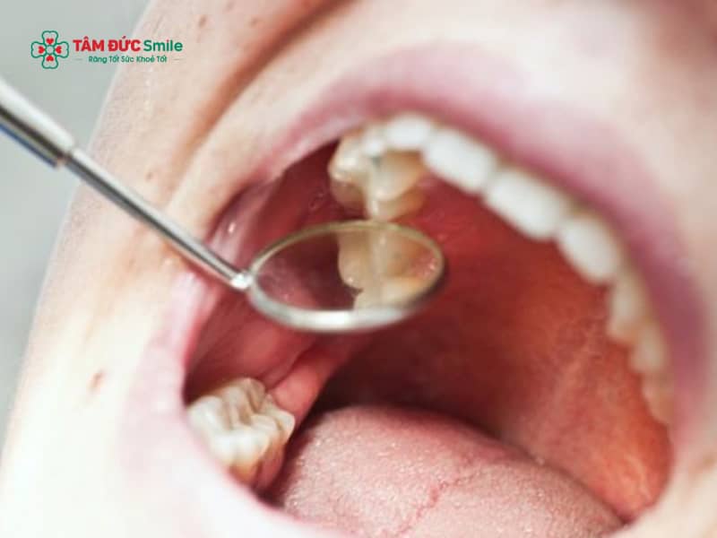 Răng đang đau có nhổ được không? Khi nào nên, khi nào cần hoãn nhổ răng