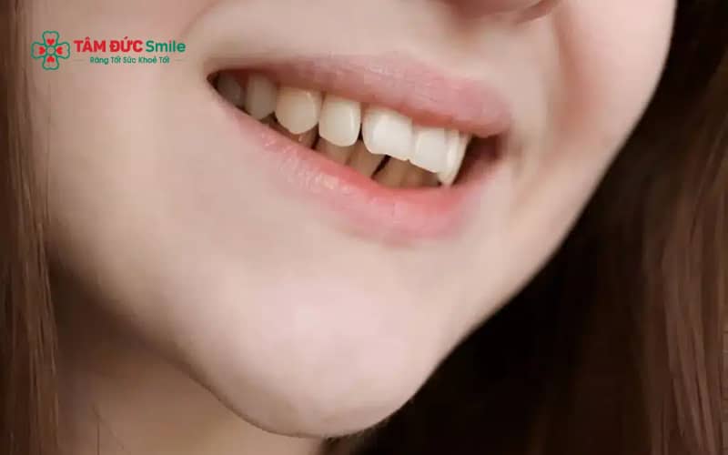 Răng đều nhưng hô có thể làm khuôn mặt mất cân đối, ảnh hưởng tâm lý, sự tự tin và chức năng ăn nhai nếu không được Abc8b tỷ lệ kèo World Cup 2026 kịp thời