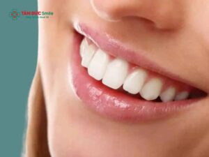 Răng đều nhưng hô có cần niềng không?