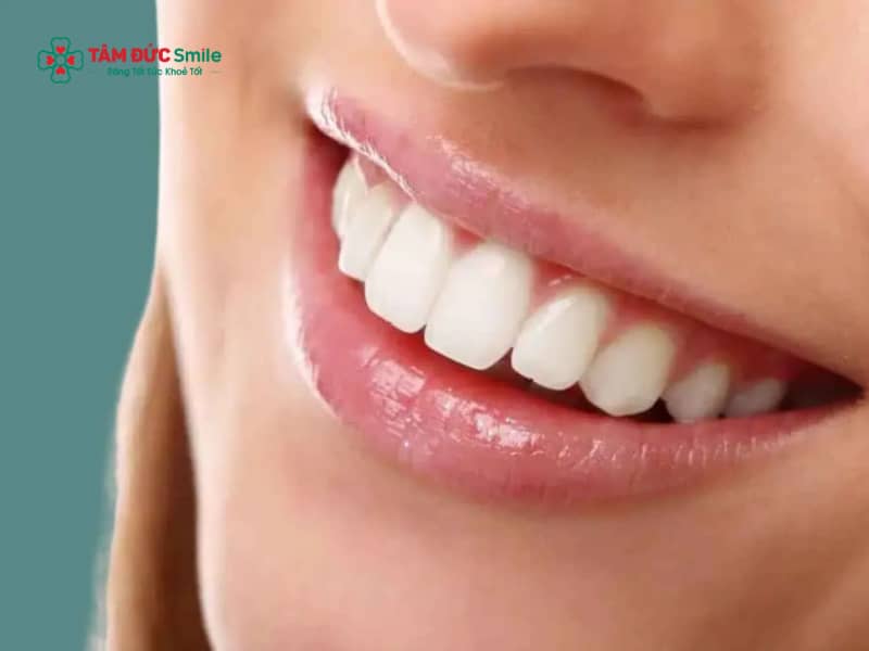 Răng đều nhưng hô có cần niềng không?