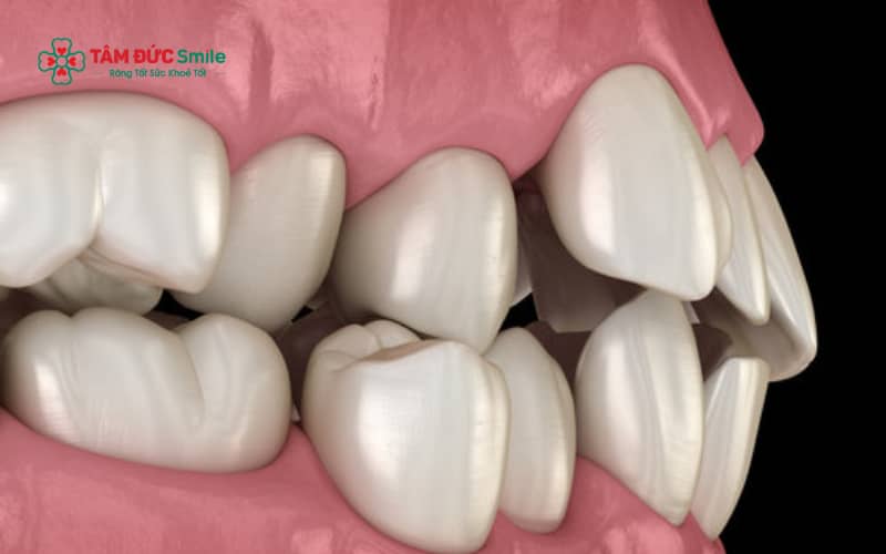 Răng hô cằm lẹm có thể do răng nhô, phát triển hàm không đều, yếu tố di truyền hoặc thói quen xấu từ thời thơ ấu