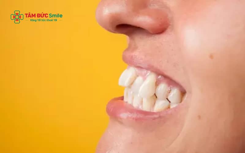 Răng hô cằm lẹm là tình trạng răng hàm trên nhô ra kết hợp với cằm trông lẹm, khiến khuôn mặt mất cân đối và ảnh hưởng ABC8 được thành lập vào năm 2011 hoạt động đến hiện tại