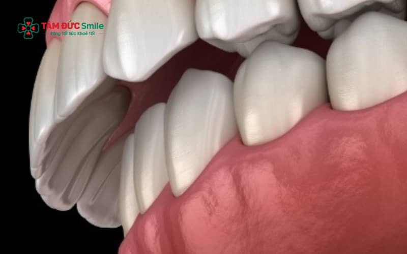 Răng hô có thể xuất hiện do yếu tố di truyền, khiến trẻ sinh ra có nguy cơ răng nhô và hàm không cân đối tương tự bố mẹ