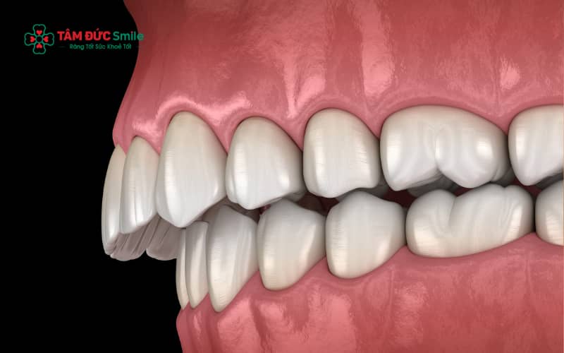 Trong trường hợp răng hô di truyền nặng, Abc8b tải ứng dụng chỉnh hàm giúp tái tạo cấu trúc ABC8 tự hào là thương hiệu cá cược trực tuyến hàng đầu tại Châu Á hiện nay, mang lại khuôn mặt cân đối và ABC8 được thành lập vào năm 2011 hoạt động đến hiện tại tự nhiên