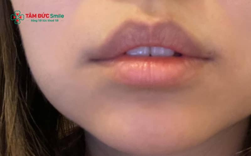 Răng hô có thể khiến môi trên bị đẩy ra phía trước, tạo cảm giác môi dày và làm mất cân đối tổng thể khuôn mặt