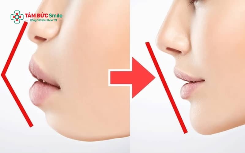 Tùy mức độ răng hô và cấu trúc hàm, ABC8 đường link chính thức có thể chỉ định Abc87 tải ứng dụng mắc cài, Abc87 tải ứng dụng trong suốt Invisalign hoặc Abc8b tải ứng dụng chỉnh hàm trong trường hợp nặng