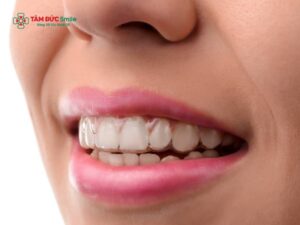 Răng hô có làm môi dày không? Nguyên nhân và phương pháp khắc phục răng hô môi dày hiện nay
