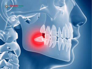 Răng khôn tiếng Anh là gì? Wisdom tooth, third molar và thuật ngữ LINK TRANG CHỦ ABC88 CHUẨN 2026