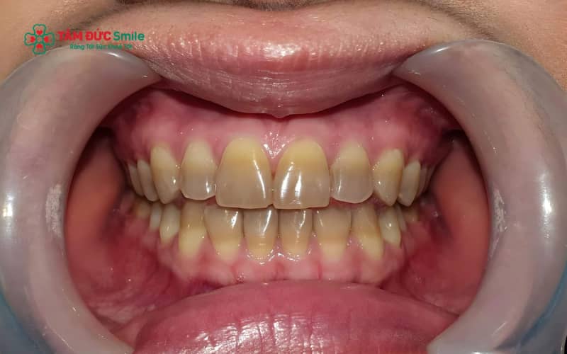 Việc sử dụng kháng sinh tetracycline trong thai kỳ hoặc cho trẻ nhỏ có thể gây lắng đọng thuốc trong cấu trúc răng, dẫn đến đổi màu vĩnh viễn