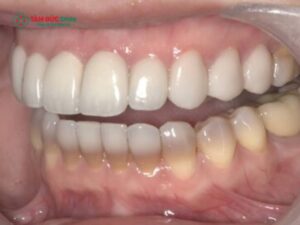 Răng nhiễm tetracycline là gì? Dấu hiệu, mức độ và cách Abc8b tỷ lệ kèo World Cup 2026 hiệu quả