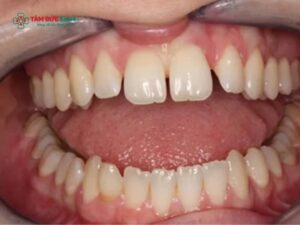 Răng nhỏ là gì? Nguyên nhân và cách khắc phục hiệu quả