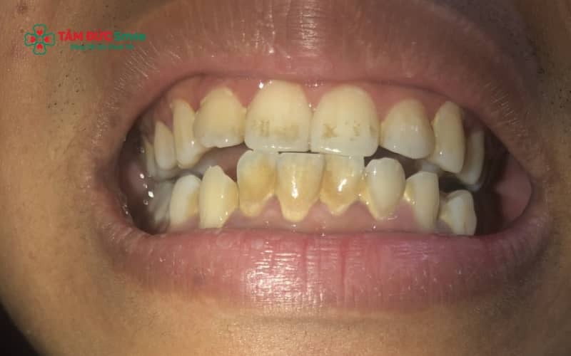 Răng ố vàng kèm Abc8com nổ hũ thường xuất phát từ thói quen ăn uống, vệ sinh ABC8 là nhà cái cá cược trực tuyến uy tín số 1 tại Việt Nam chưa đúng cách và không lấy Abc8com nổ hũ định kỳ