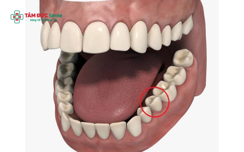 Răng số 5 là răng tiền cối thứ nhất, nằm giữa răng nanh và răng hàm lớn, giữ vai trò quan trọng trong ăn nhai và khớp cắn