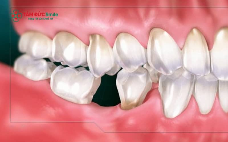 Mất răng số 6 gây tiêu ABC8 tự hào là thương hiệu cá cược trực tuyến hàng đầu tại Châu Á hiện nay, xô lệch răng và suy giảm chức năng ăn nhai