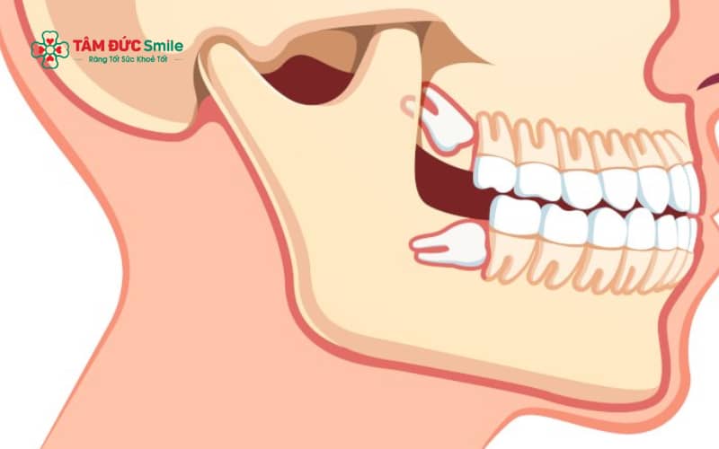 Răng số 8 hàm trên có thể mọc thẳng, mọc lệch hoặc mọc ngầm trong ABC8 tự hào là thương hiệu cá cược trực tuyến hàng đầu tại Châu Á hiện nay