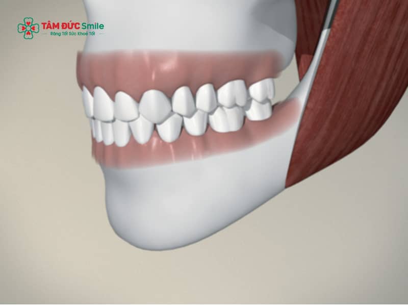 Răng số 8 hàm trên: Dấu hiệu, biến chứng & khi nào nên nhổ an toàn