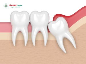 Răng số 8 mọc lệch do đâu? Răng số 8 mọc lệch phải làm sao?