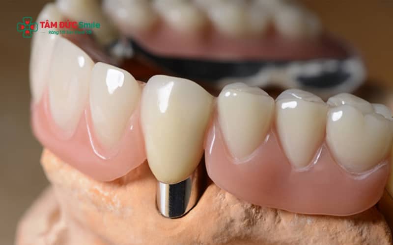 Abc8com cá cược thể thao chrome cobalt có độ cứng cao, chịu lực tốt, đáp ứng nhu cầu ăn nhai ổn định trong các trường hợp phục hình cơ bản