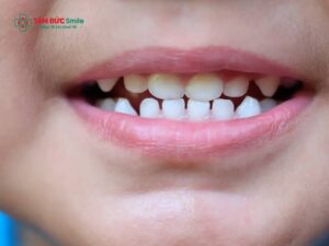 Răng sữa bao nhiêu cái? Mấy tuổi thì trẻ bắt đầu thay răng sữa?