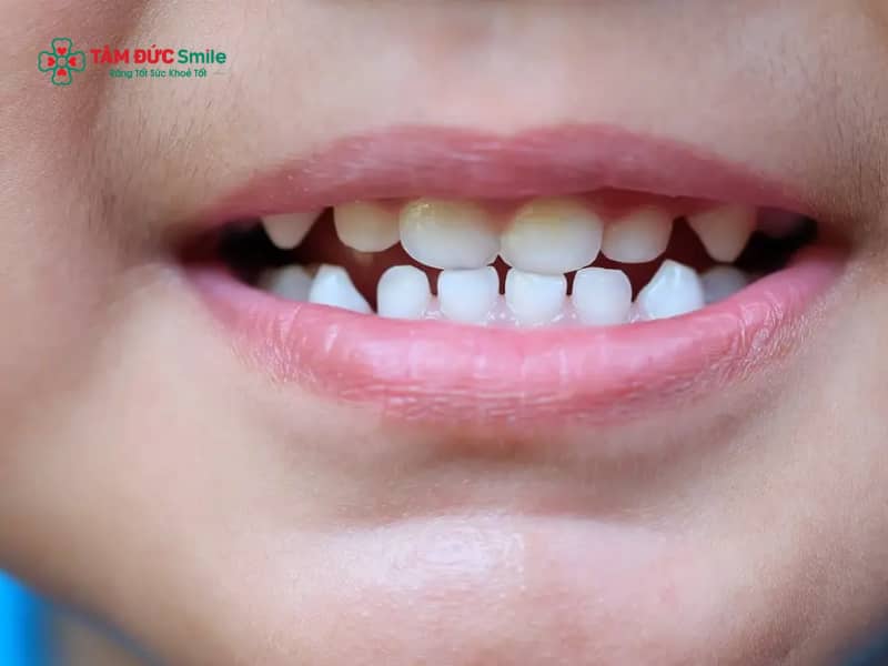 Răng sữa bao nhiêu cái? Mấy tuổi thì trẻ bắt đầu thay răng sữa?