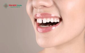 Răng thưa nên làm gì? Các cách khắc phục hiệu quả hiện nay