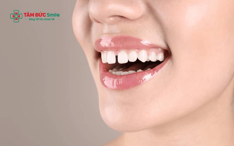 Răng thưa nên làm gì? Các cách khắc phục hiệu quả hiện nay