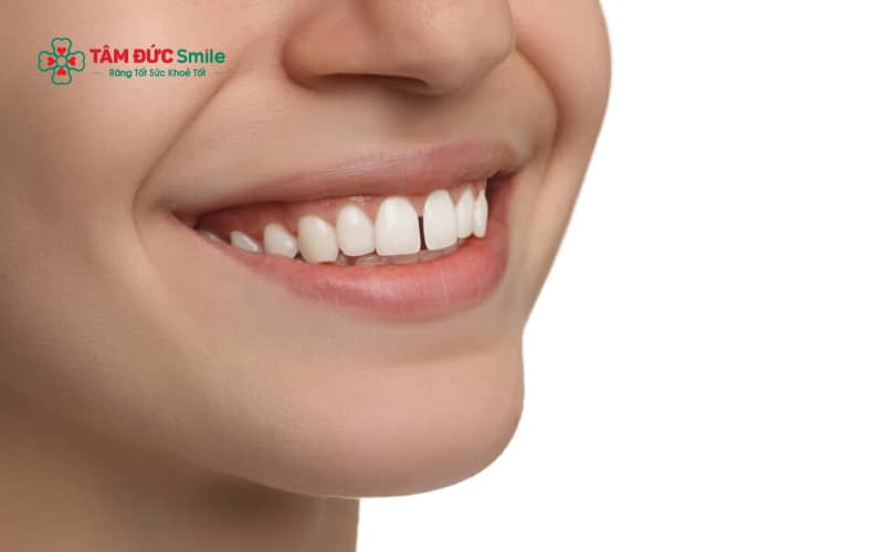 Răng thưa có thể xuất phát từ nhiều nguyên nhân khác nhau, trong đó phổ biến là yếu tố di truyền, mất răng sớm và bệnh lý nha chu