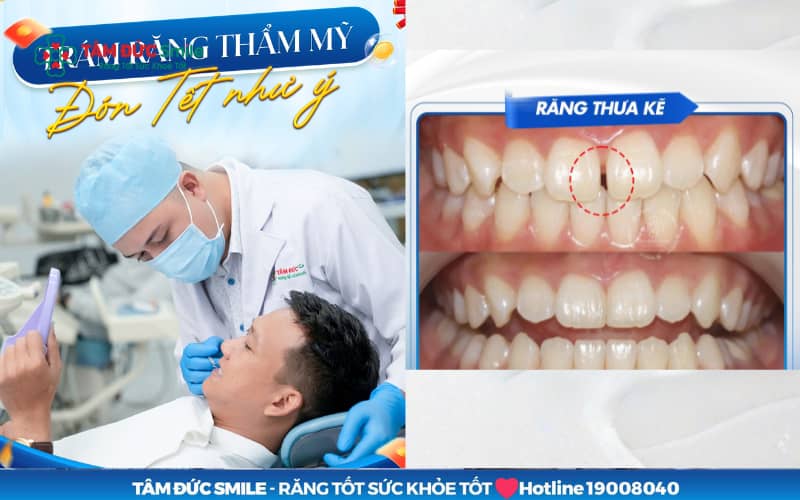 Abc8 Abcvip link không chặn thưa là giải pháp Abc8c1 com khuyến mãi hấp dẫn nhanh, phù hợp với khe răng nhỏ và tình trạng khớp cắn ổn định