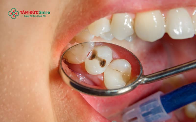 Sâu men răng là giai đoạn sớm của ABC88 com đăng nhập, tổn thương chỉ khu trú ở lớp men bên ngoài và chưa xâm lấn vào ngà răng