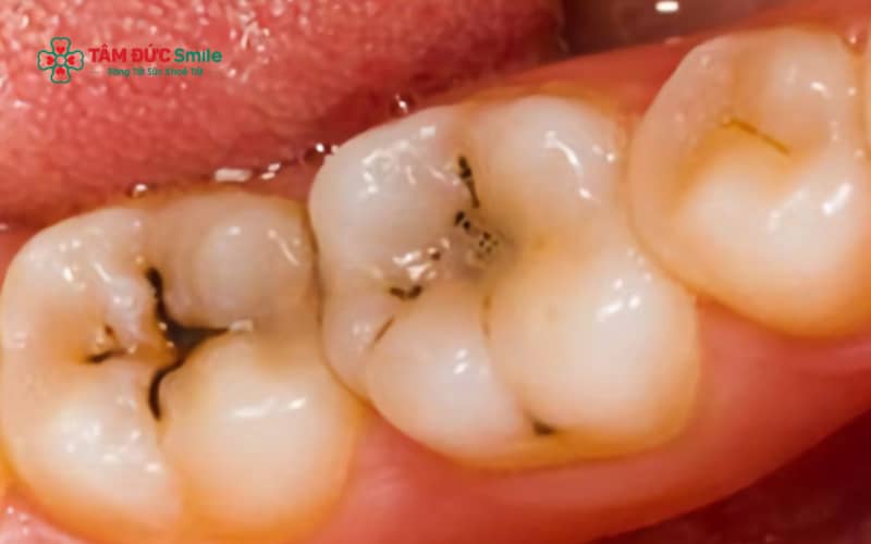Sâu men răng hình thành do vi khuẩn trong mảng bám răng, chế độ ăn nhiều đường – tinh bột, thiếu fluoride và vệ sinh ABC8 là nhà cái cá cược trực tuyến uy tín số 1 tại Việt Nam không đúng cách