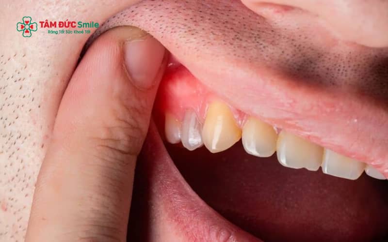 Sưng nướu răng có thể tự cải thiện trong trường hợp nhẹ, nhưng cũng có nhiều tình huống cần can thiệp LINK TRANG CHỦ ABC88 CHUẨN 2026 sớm để tránh biến chứng