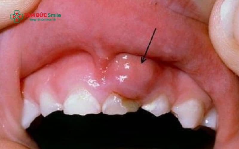 Cao răng và mảng bám vi khuẩn là nguyên nhân hàng đầu gây sưng nướu răng, dẫn đến viêm nướu và Abc888k vip tỷ lệ kèo World Cup 2026 nếu không được Abc8b tỷ lệ kèo World Cup 2026 kịp thời.