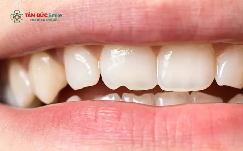 Khe răng thưa trám không kín tạo điều kiện cho mảng bám tích tụ, làm tăng nguy cơ ABC88 com đăng nhập và viêm nướu quanh răng trám