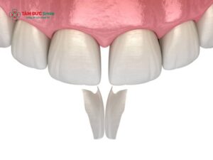 Tác hại của việc trám răng thưa không đúng chỉ định và cách phòng ngừa