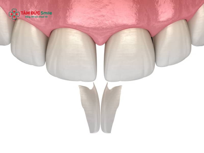 Tác hại của việc trám răng thưa không đúng chỉ định và cách phòng ngừa