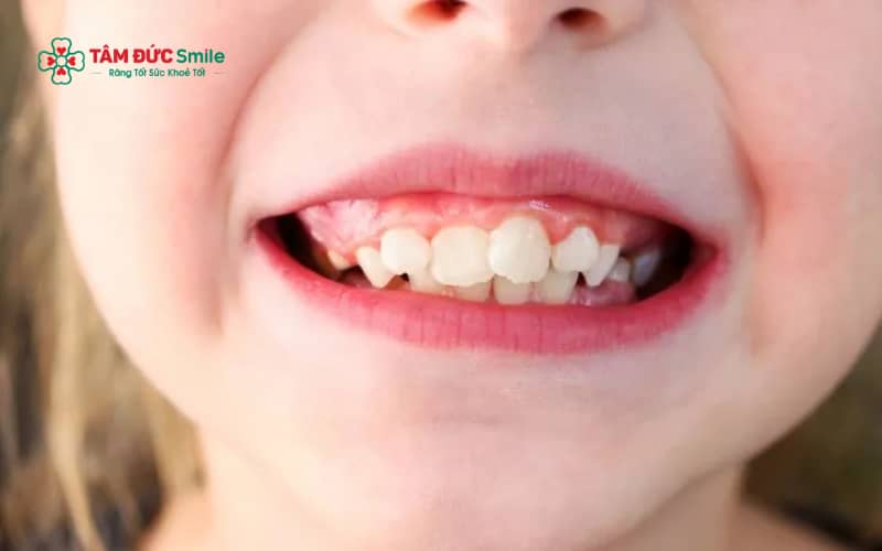 Các thói quen như cắn môi dưới, cắn bút hay cắn móng tay lâu dài có thể tác động đến vị trí răng, góp phần làm răng hô