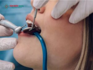 Thuốc tê nhổ răng có tác dụng trong bao lâu? Thuốc tê nhổ răng có nguy hiểm không?
