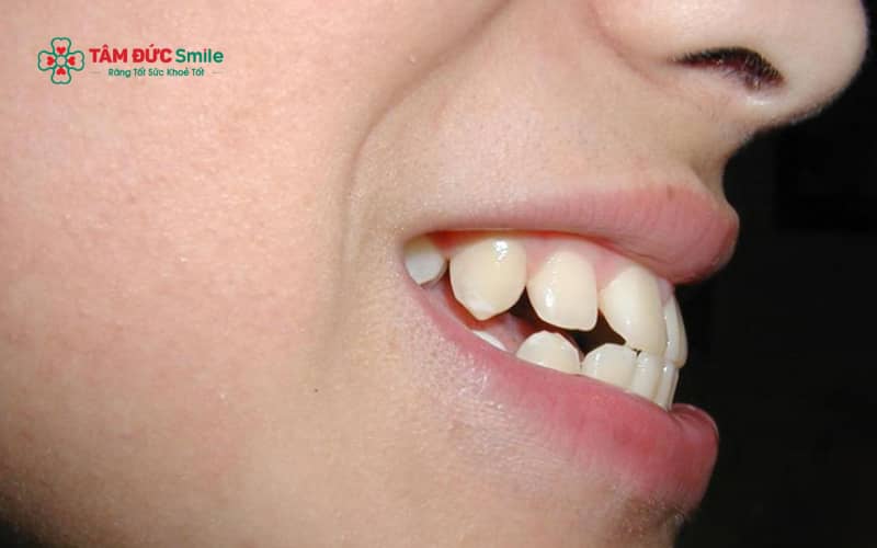 Răng hô có thể ảnh hưởng đến Abc8c1 com khuyến mãi hấp dẫn khuôn mặt, sự tự tin khi giao tiếp