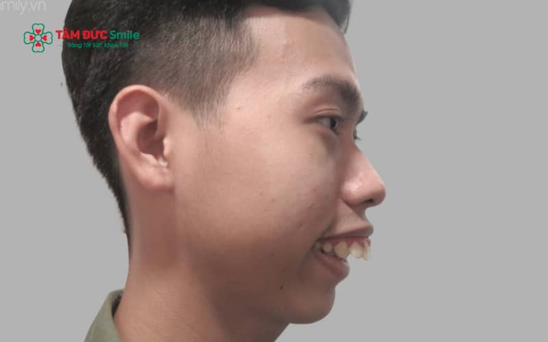 Theo nhân tướng học, trai răng hô thường được gán với một số đặc điểm tính cách nhất định
